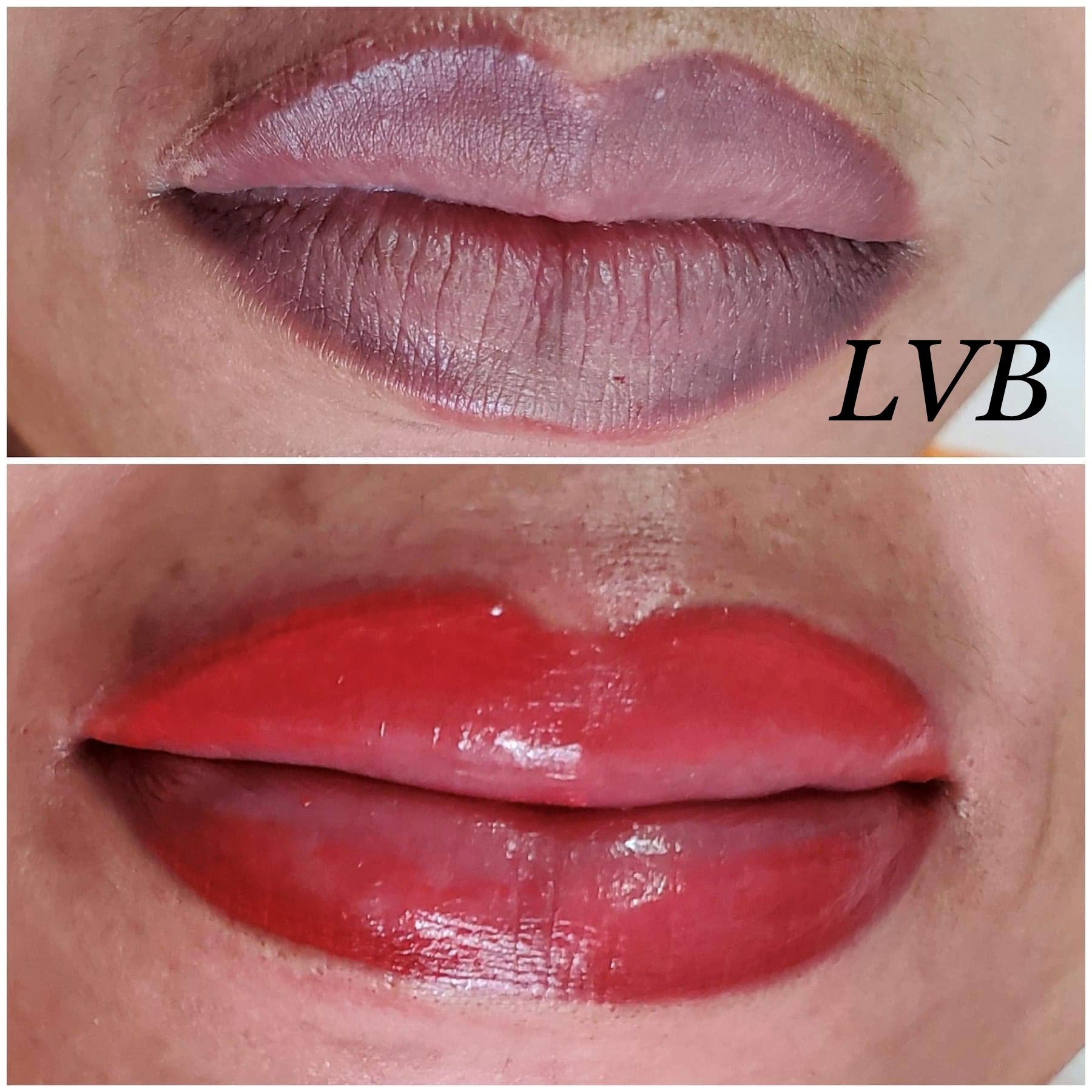 avant et après le traitement des lèvres