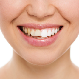 Before/After teeth whitening